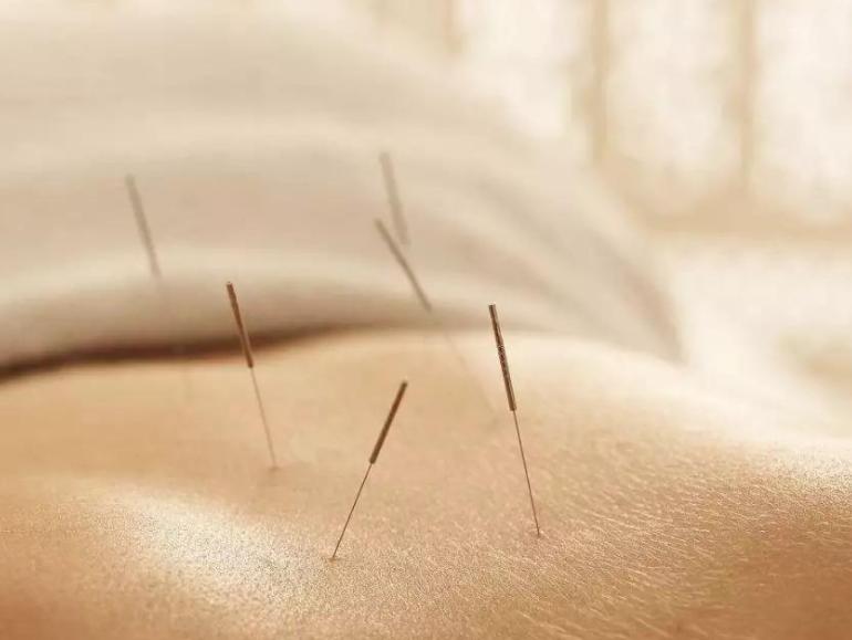 针灸后能热敷吗针灸的十大禁忌,腰突针灸的十大禁忌有哪些