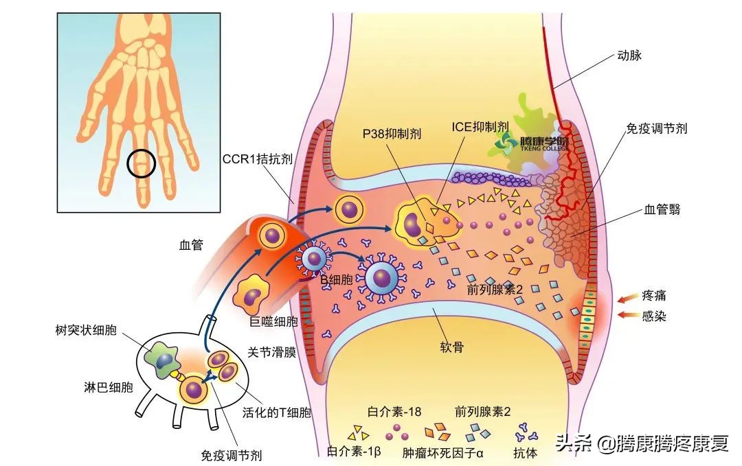 类风湿关节炎病因与发病机制,类风湿关节炎的病因与发病机制