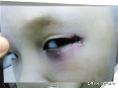 石灰粉伤眼睛,石灰粉对眼睛的伤害