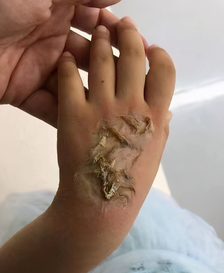 儿童电话手表为什么会烧伤,电话手表爆燃烧伤女童