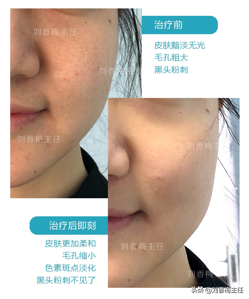 毛孔粗大快速美白,想美白脸最好的方法是什么