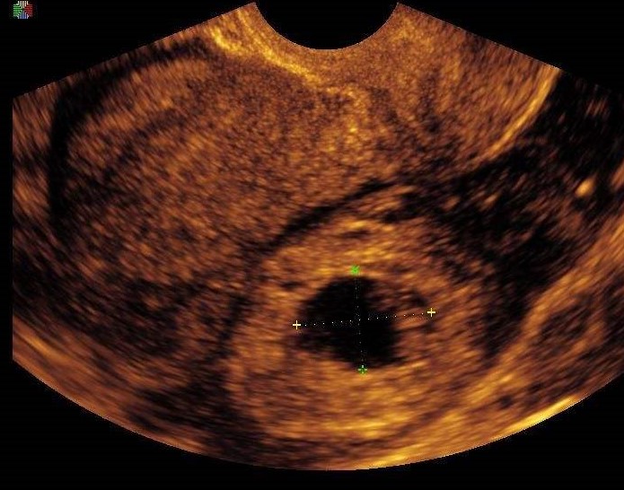 宫外孕失去生命案例,宫外孕奇迹存活