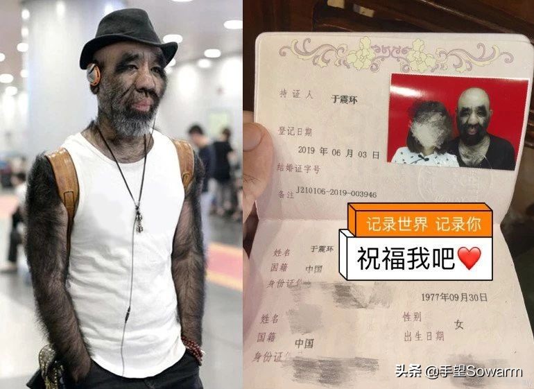 全世界体毛最多的人，是如何在歧视中逆袭为实力派歌手的？