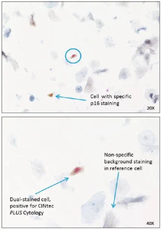 「一路有理」优化诊断，让高级别病变不再“隐形”