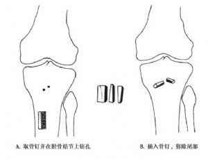 11岁孩子膝盖下方疼是生长痛吗,十四岁孩子膝盖下一点尖骨疼