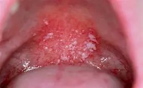 一个月宝宝口腔上颚白色的是什么,婴儿口腔上颚有一个小米样的白点