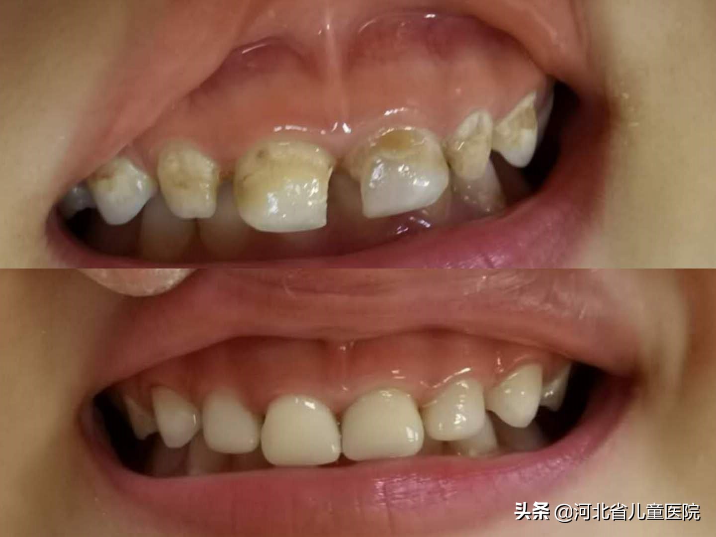 孩子牙齿龋齿怎么来保护,后牙龈边缘变黑龋坏