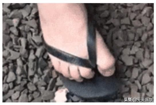 脚气治疗过程中的注意事项,脚气的注意事项