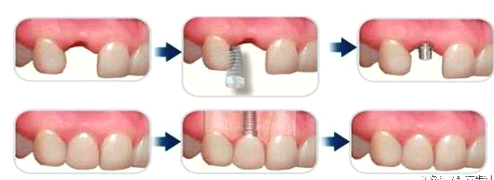 植牙假牙角度,全口活动假牙案例