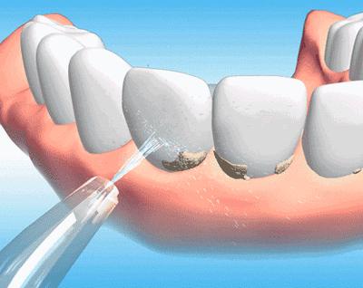 用冲牙器会把托槽冲掉吗,戴托槽牙套饭后只用冲牙器可以吗