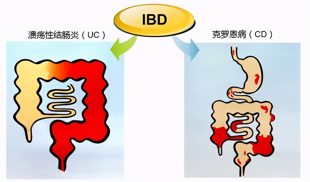 肠功能性紊乱顽固性腹泻,反复腹泻要警惕炎症性肠病