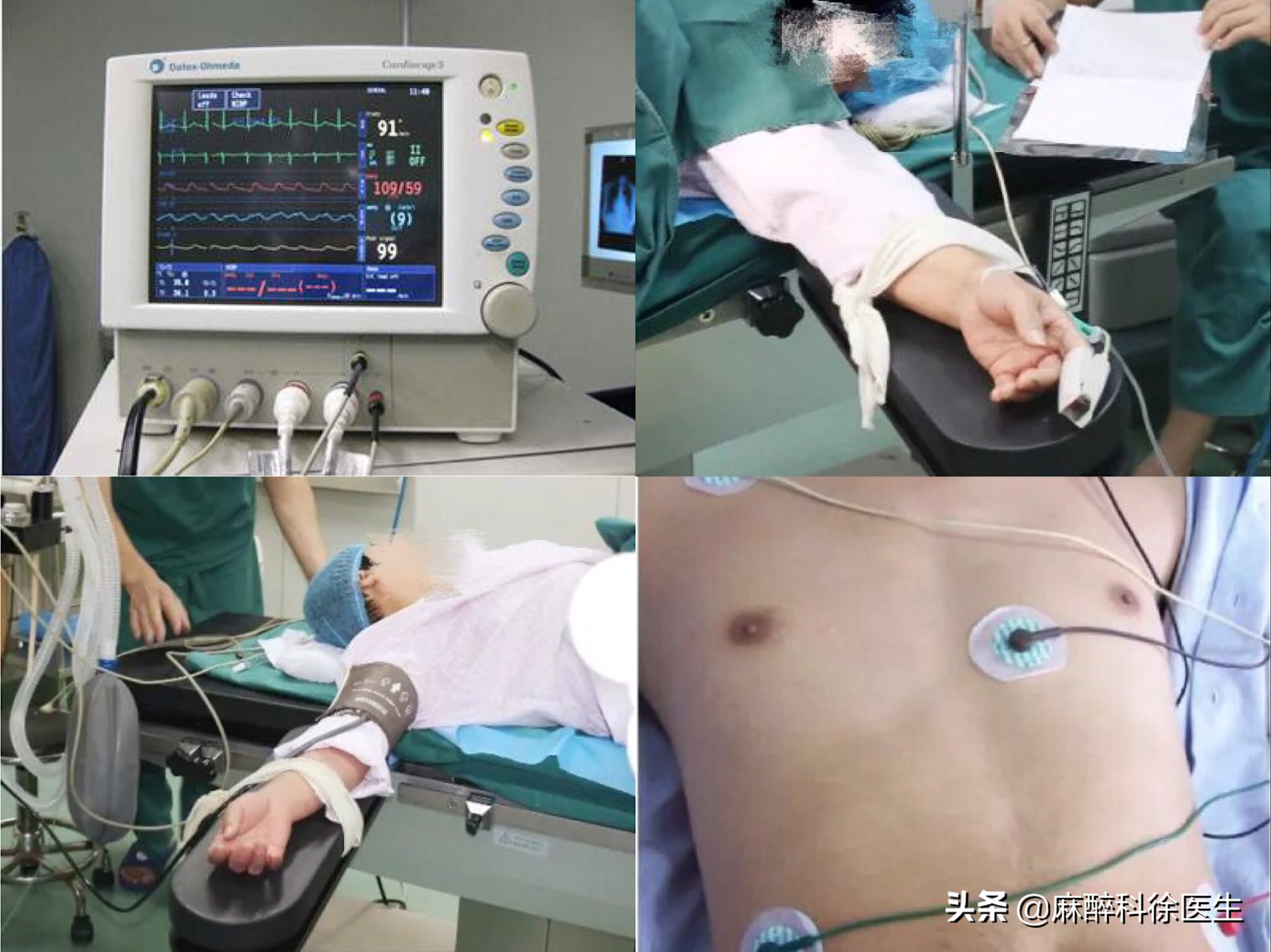 局部麻醉是什么体验,麻醉就是麻醉什么感觉