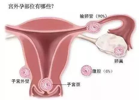 女性30岁因宫外孕破裂大出血入院,19岁宫外孕险些丧命