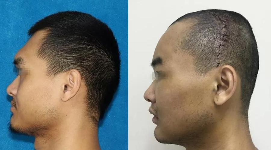 眉弓多高最合适,眉弓怎么判断高低