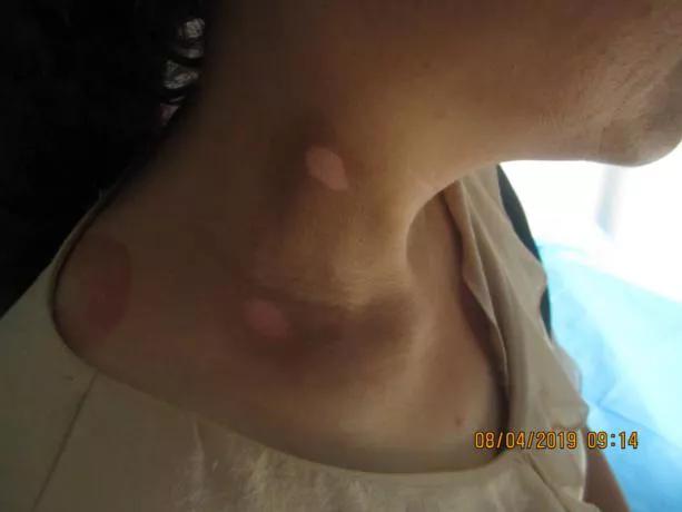 白癜风女子坚持抗复发,白癜风康复了的女孩