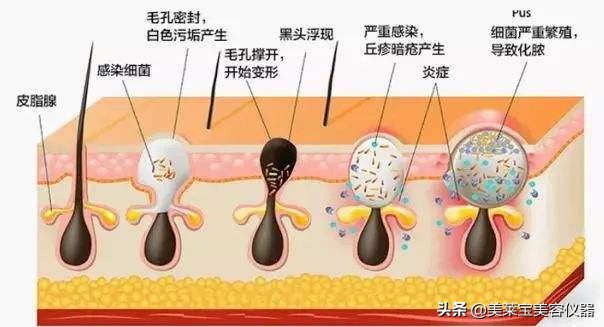 去闭口黑头粉刺真实测评,粉刺黑头用什么美容仪器