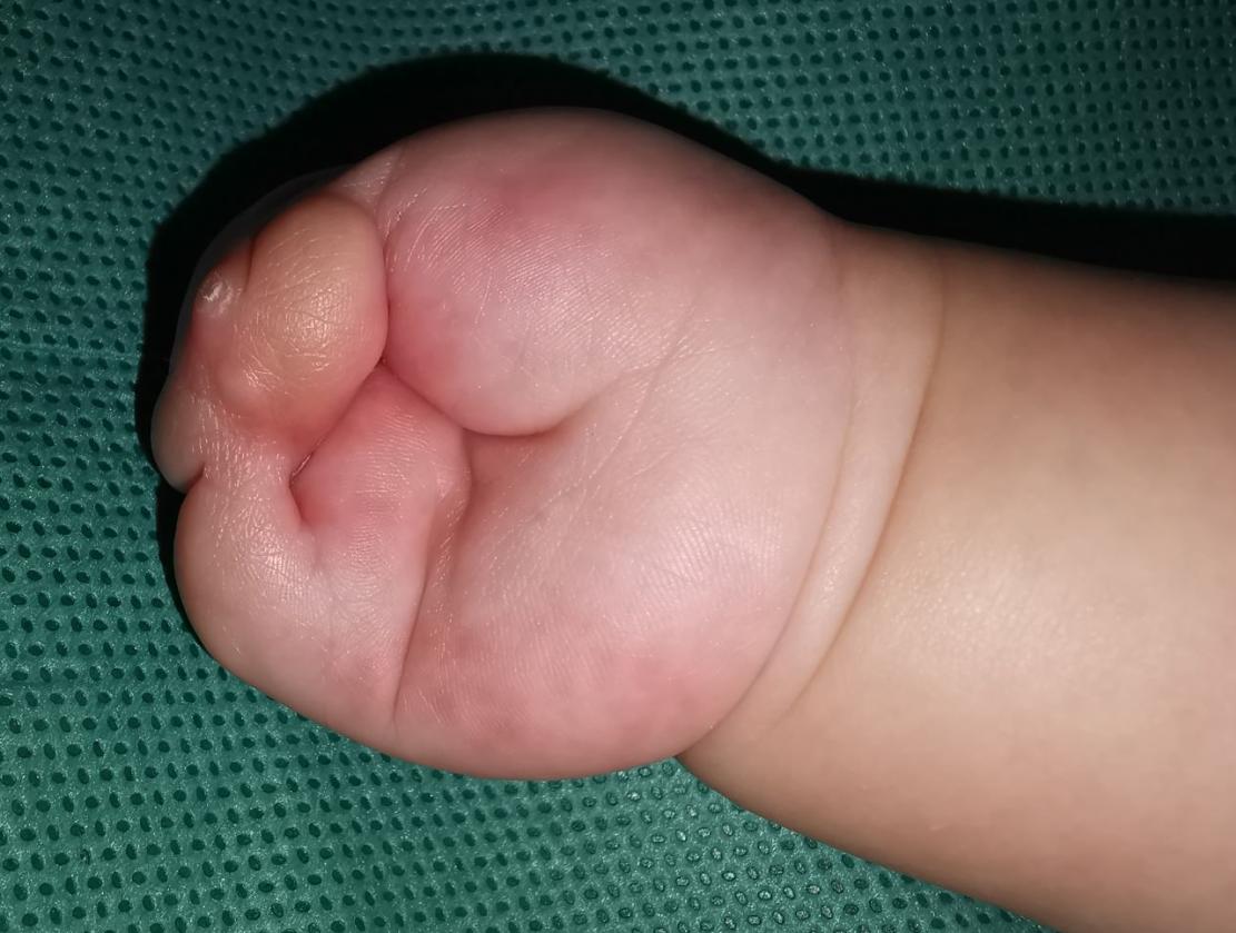 并指畸形免植皮案例,并指畸形