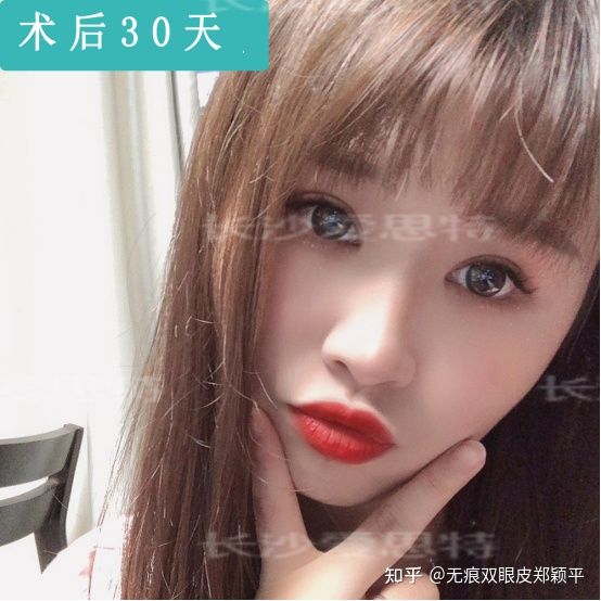 割双眼皮几毫米最好看,割双眼皮真的会好看吗