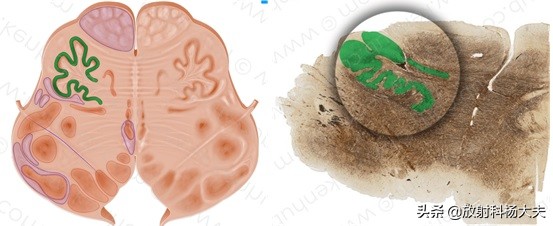 脑出血几年以后复发,脑出血几年后偏瘫越来越严重