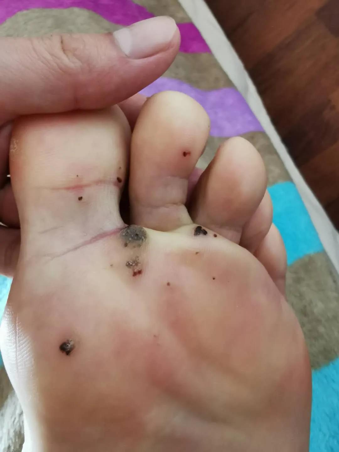 火针治疗跖疣有效果吗,火针点刺治疗跖疣