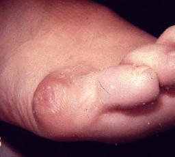 小脚趾拇囊炎的治疗方法,小脚趾侧边肿痛用什么药