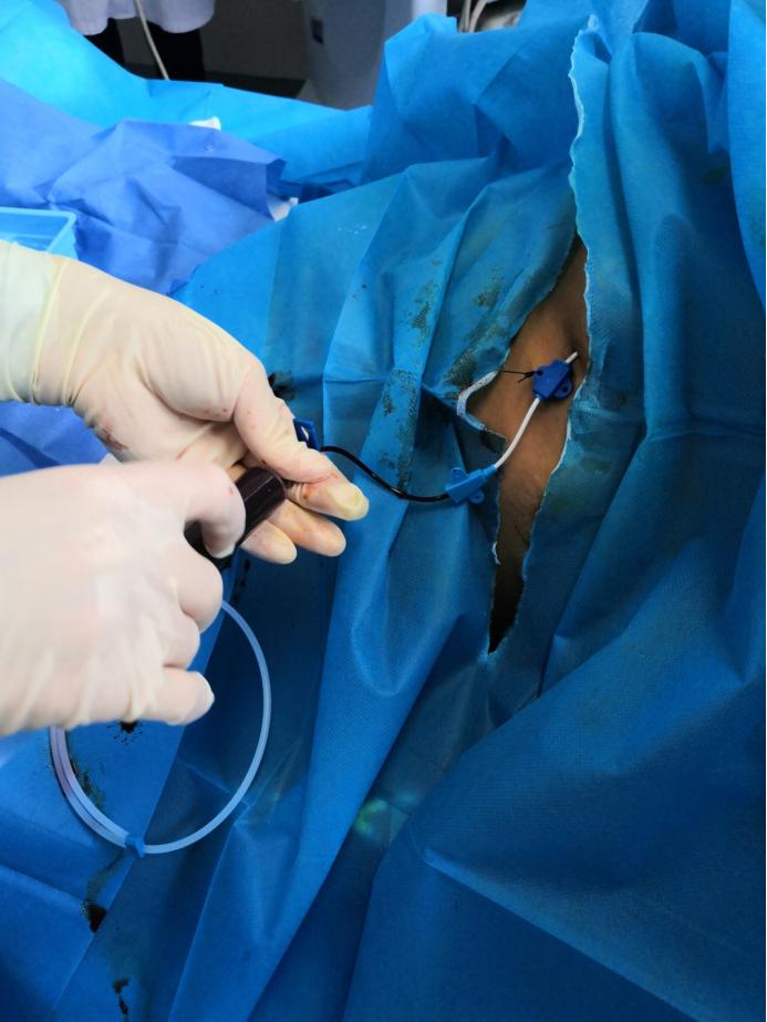 肾积液心包积液,肾移植有积液怎么回事