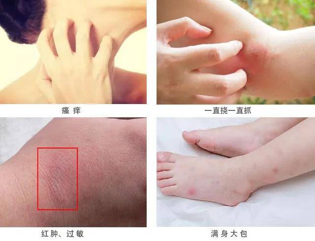 杨幂拍戏被蚊子叮满包？易烊千玺被咬出血？明星们怎么强效驱蚊？