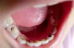 一口黄牙竟让形象尽毁！‘到手香’帮你重新找回自信！大胆开笑