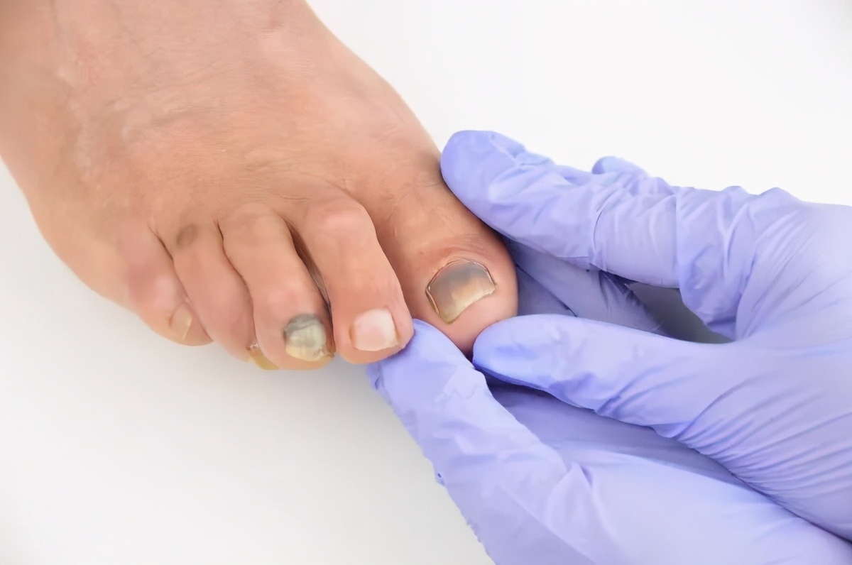 老人得了灰指甲怎么办,得了灰指甲一个传染俩