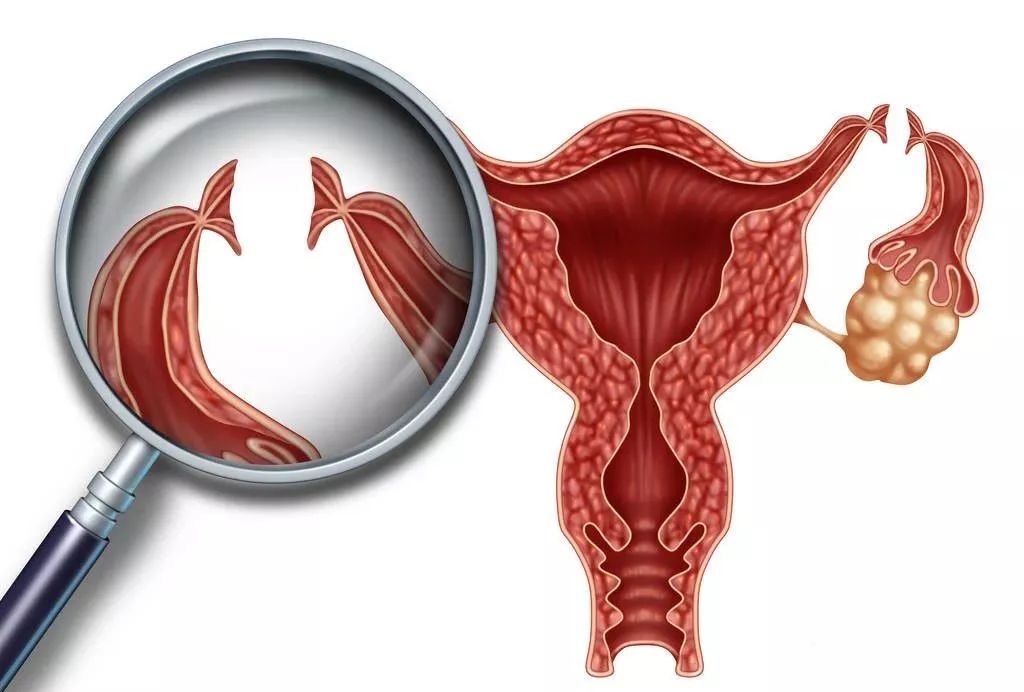 卵巢癌早期6个症状，越早发现越能救命！