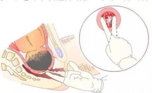 生完孩子产道多久可以恢复,生孩子为什么产道可以撑那么大