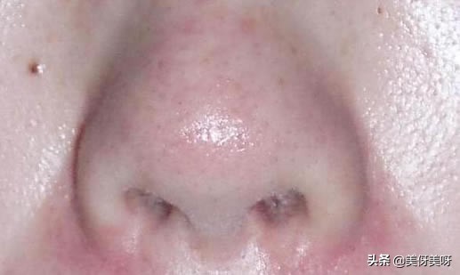 长黑头的原因和改善方法,黑头前面长出了白头怎么去掉