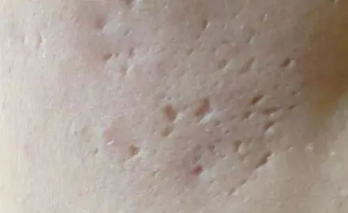 月球表面的痘坑能去掉吗,像毛孔一样的痘坑怎么修复