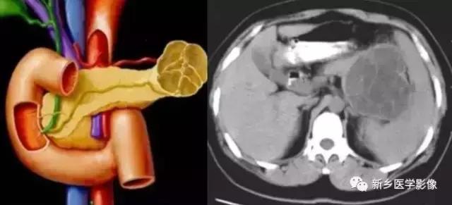 18种胰腺肿瘤，为什么我就知道两种