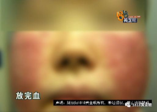 为了变美打整形针,为了美打除皱脸肿图片