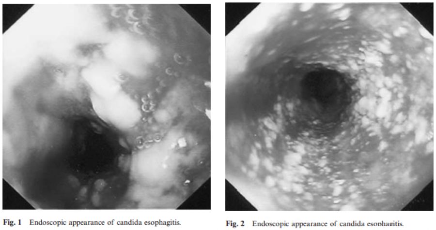 慢阻肺患者合并真菌感染,慢阻肺和真菌定植有关系吗