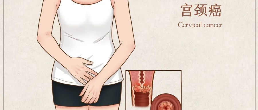 宫颈鳞癌和宫颈癌哪个更严重,宫颈癌前病变科普