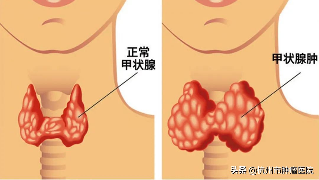 查出甲状腺结节其实是好事,目前查出甲状腺结节的人越来越多
