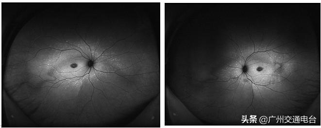 小孩检查眼睛弱视是怎么回事,发现13岁小孩弱视怎么做眼底检查