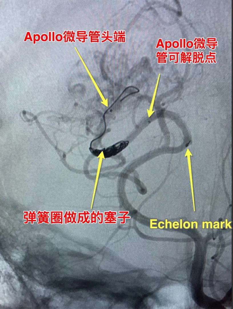 脑动静脉畸形介入栓塞手术的风险,介入栓塞技术在脑avm治疗中的作用