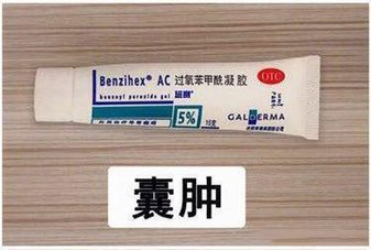 痘痘闭口药膏,闭口黑头痘痘药膏推荐