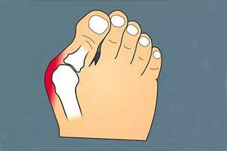 痛风高尿酸运动,痛风跑步尿酸会升高吗