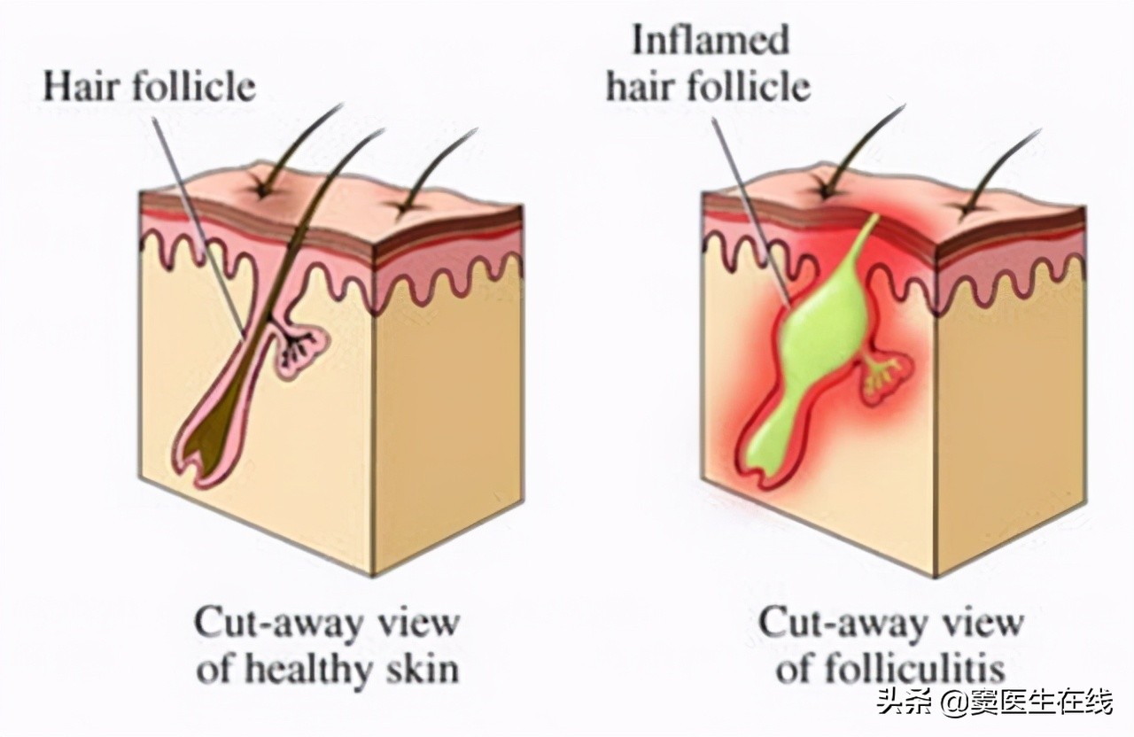 体毛要不要刮掉要一直处理吗,体毛刮掉对身体有什么影响