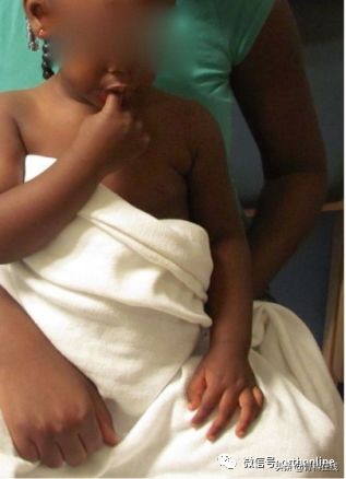 儿童桡骨小头半脱位复位视频,桡骨小头半脱位1周还能复位吗