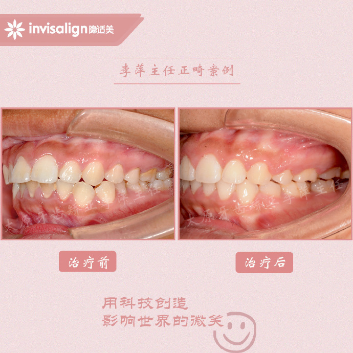 龅牙矫正牙齿能解决下颌后缩么,儿童正畸能解决鼻基底凹陷问题吗