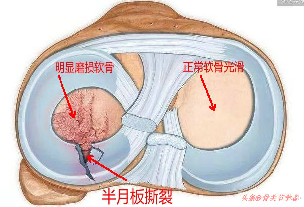膝关节磁共振如何识别半月板损伤,磁共振半月板越来越严重怎么回事