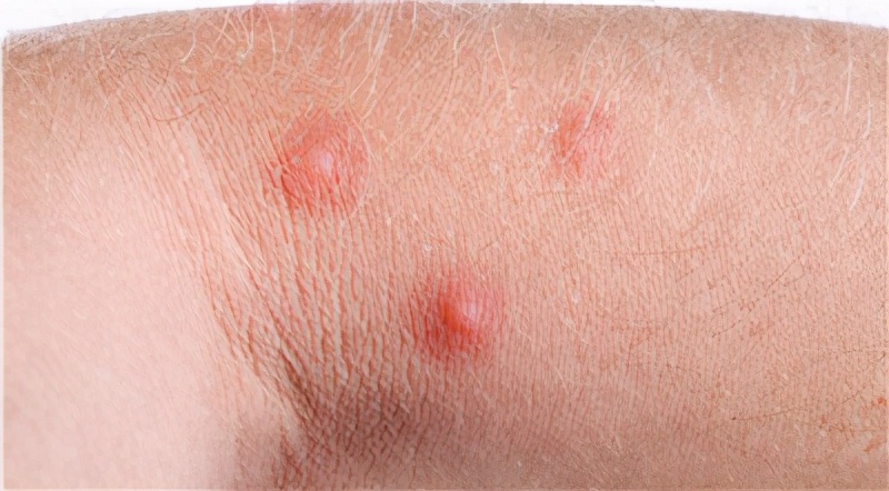 挠痒快速止痒妙招,夏季过敏性皮炎痒了能挠吗