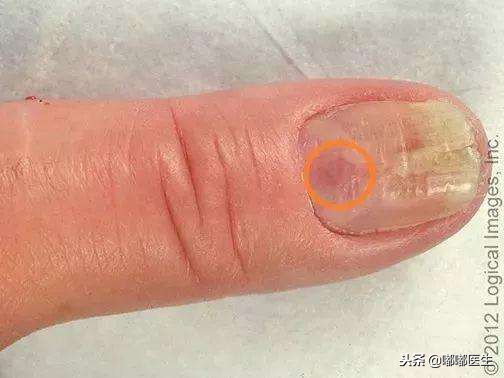 指甲有白点肚子里有蛔虫？月牙越大越健康？指甲软是缺钙……