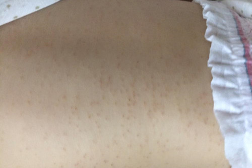 宝宝湿疹反反复复，妈妈应当怎样做呢？