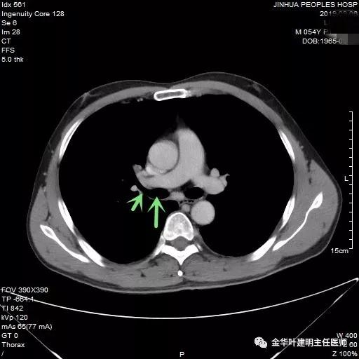 省级医院也漏诊?还好没耽误病情!我们予以行右中下叶袖式切除术